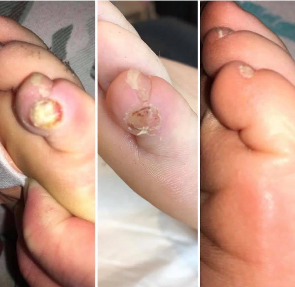 Verruca before and after one cryotherapy session